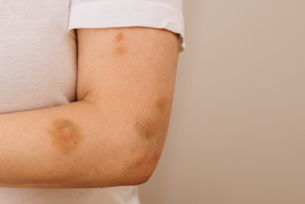 Woman with bruises on her arm. 