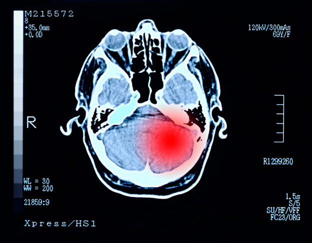 Xray scan showing brain injury