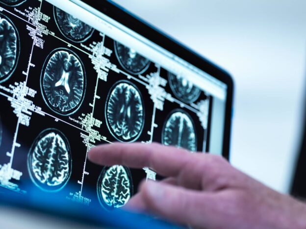 Hand pointing at a brain scan.